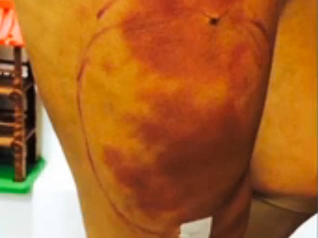 <br> Andressa Urach mostrou o problema que teve com o hidrogel na perna <br> Andressa Urach mostrou o problema que teve com o hidrogel na perna