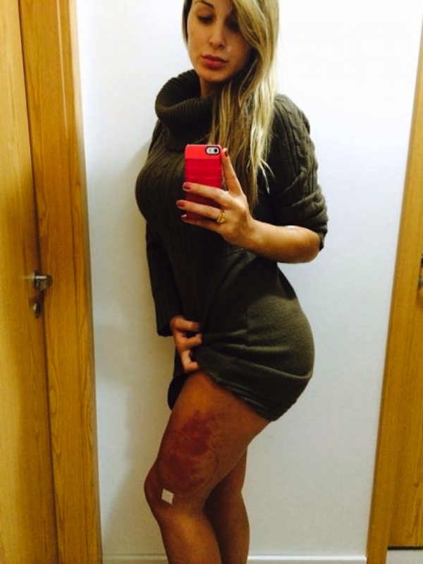 Andressa Urach mostrou o problema que teve com o hidrogel na perna Andressa Urach mostrou o problema que teve com o hidrogel na perna