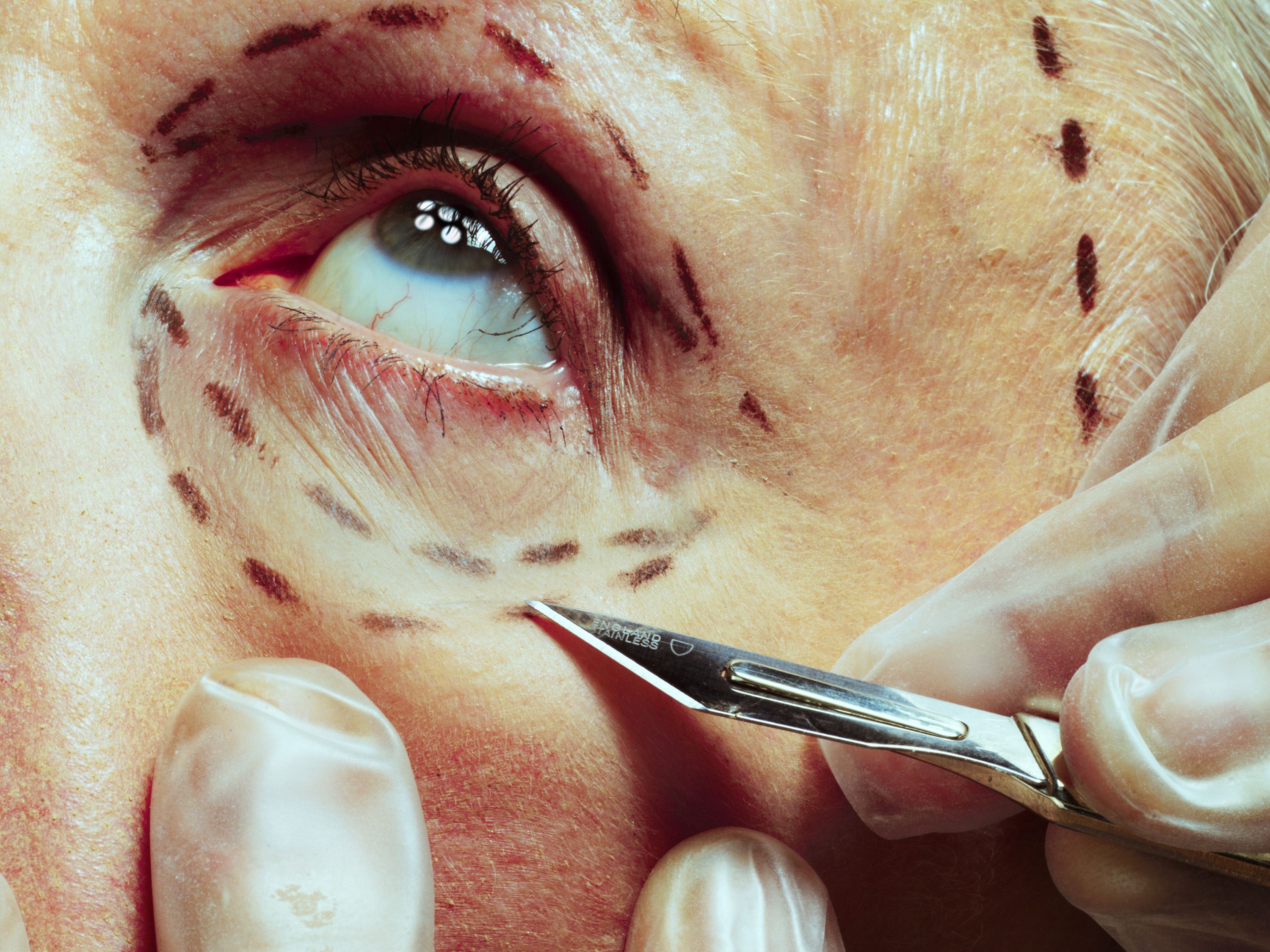 Blefaroplastia já é a cirurgia estética mais realizada no mundo