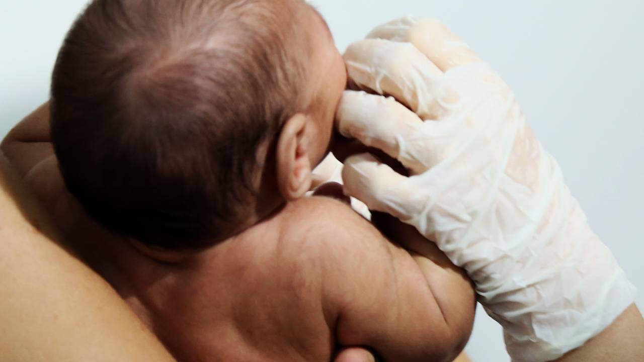 Primeiros pacientes com microcefalia a receber atendimento na Policlínica Lessa de Andrade, no bairro da Madalena, na zona oeste do Recife (PE)
