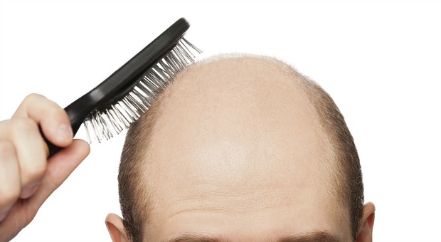 Remédio para artrite faz crescer cabelo – e muito – em homem careca