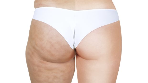 Celulite: as regras básicas para prevenir e reduzir o problema