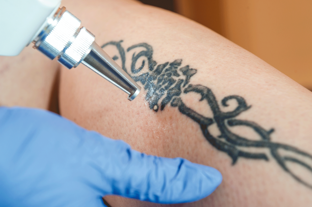 Descoberta abre caminho para técnica de remoção de tatuagens