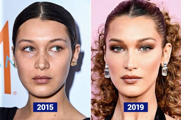 BELLA HADID, 22 ANOS - A modelo americana, que faturou 33 milhões de reais em 2018, mudou todo o rosto: afilou o nariz, preencheu a boca e levantou as sobrancelhas. A mudança mais perceptível está no formato do rosto: passou do redondo para o retangular graças às injeções de ácido hialurônico nas maçãs, nos maxilares e no queixo. Resultado: bastante visível BELLA HADID, 22 ANOS - A modelo americana, que faturou 33 milhões de reais em 2018, mudou todo o rosto: afilou o nariz, preencheu a boca e levantou as sobrancelhas. A mudança mais perceptível está no formato do rosto: passou do redondo para o retangular graças às injeções de ácido hialurônico nas maçãs, nos maxilares e no queixo. Resultado: bastante visível