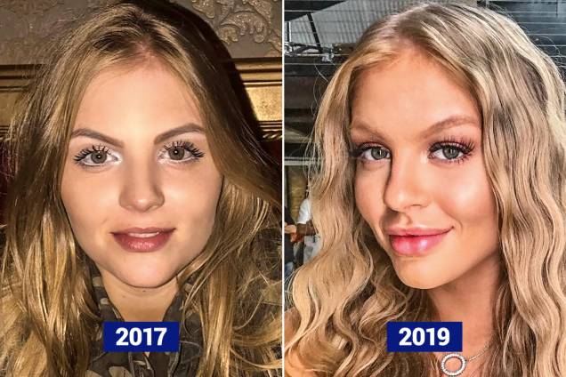 LUÍSA SONZA, 20 ANOS - A cantora gaúcha reconhece ter colocado somente preenchedor em seus lábios, agora tão carnudos quanto os de Kim Kardashian. Uma análise mais minuciosa, no entanto, mostra outras interferências: nariz levemente arrebitado, maçãs saltadas e queixo afilado e saliente. Resultado: bastante visível LUÍSA SONZA, 20 ANOS - A cantora gaúcha reconhece ter colocado somente preenchedor em seus lábios, agora tão carnudos quanto os de Kim Kardashian. Uma análise mais minuciosa, no entanto, mostra outras interferências: nariz levemente arrebitado, maçãs saltadas e queixo afilado e saliente. Resultado: bastante visível