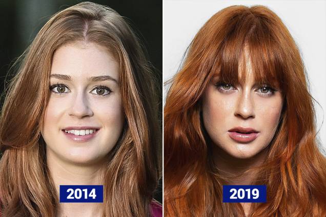 MARINA RUY BARBOSA, 24 ANOS - Uma das atrizes mais lindas do Brasil, Marina Ruy Barbosa de-tes-ta falar de procedimentos estéticos. Seus lábios, no entanto, não enganam: foram preenchidos de forma a deixar uniforme o volume das partes inferior e superior. O queixo ficou mais pronunciado. Resultado: efetivo, mas discreto MARINA RUY BARBOSA, 24 ANOS - Uma das atrizes mais lindas do Brasil, Marina Ruy Barbosa de-tes-ta falar de procedimentos estéticos. Seus lábios, no entanto, não enganam: foram preenchidos de forma a deixar uniforme o volume das partes inferior e superior. O queixo ficou mais pronunciado. Resultado: efetivo, mas discreto