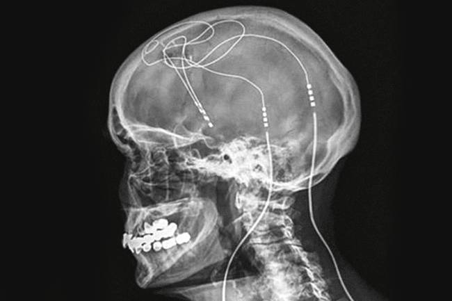 X-RAY X-RAY
