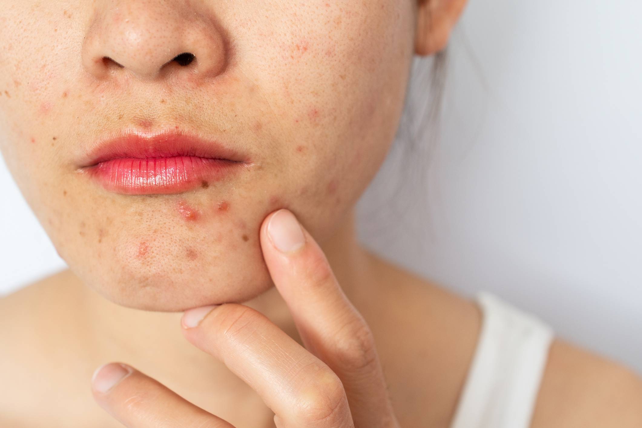 Cravos e espinhas: nova diretriz europeia atualiza tratamento da acne após 10 anos