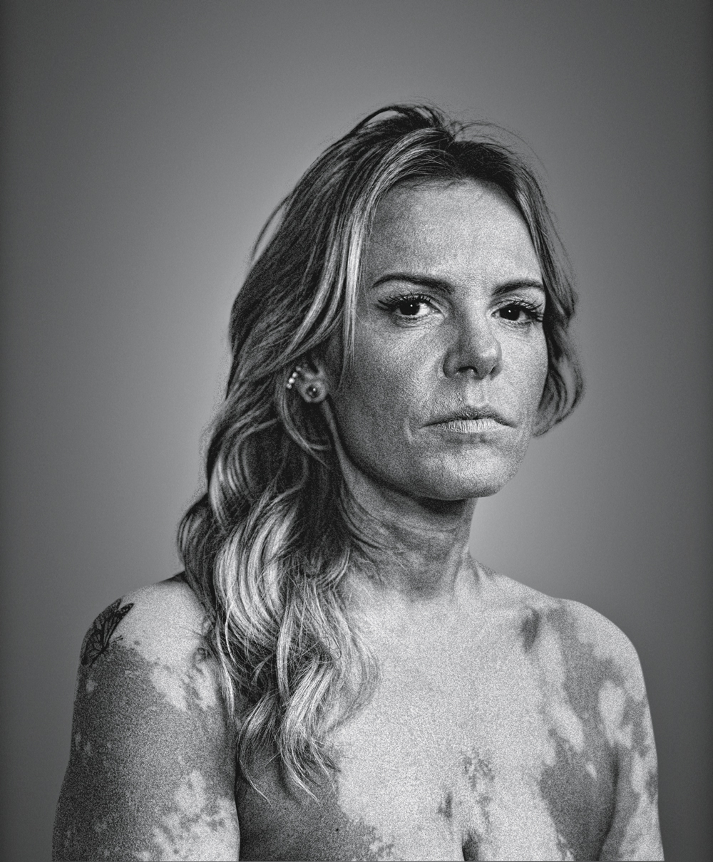 MILENA-SATYRO-VITILIGO-PRIMEIRA-PESSOA-2022-01.jpg2 Milena Satyro -