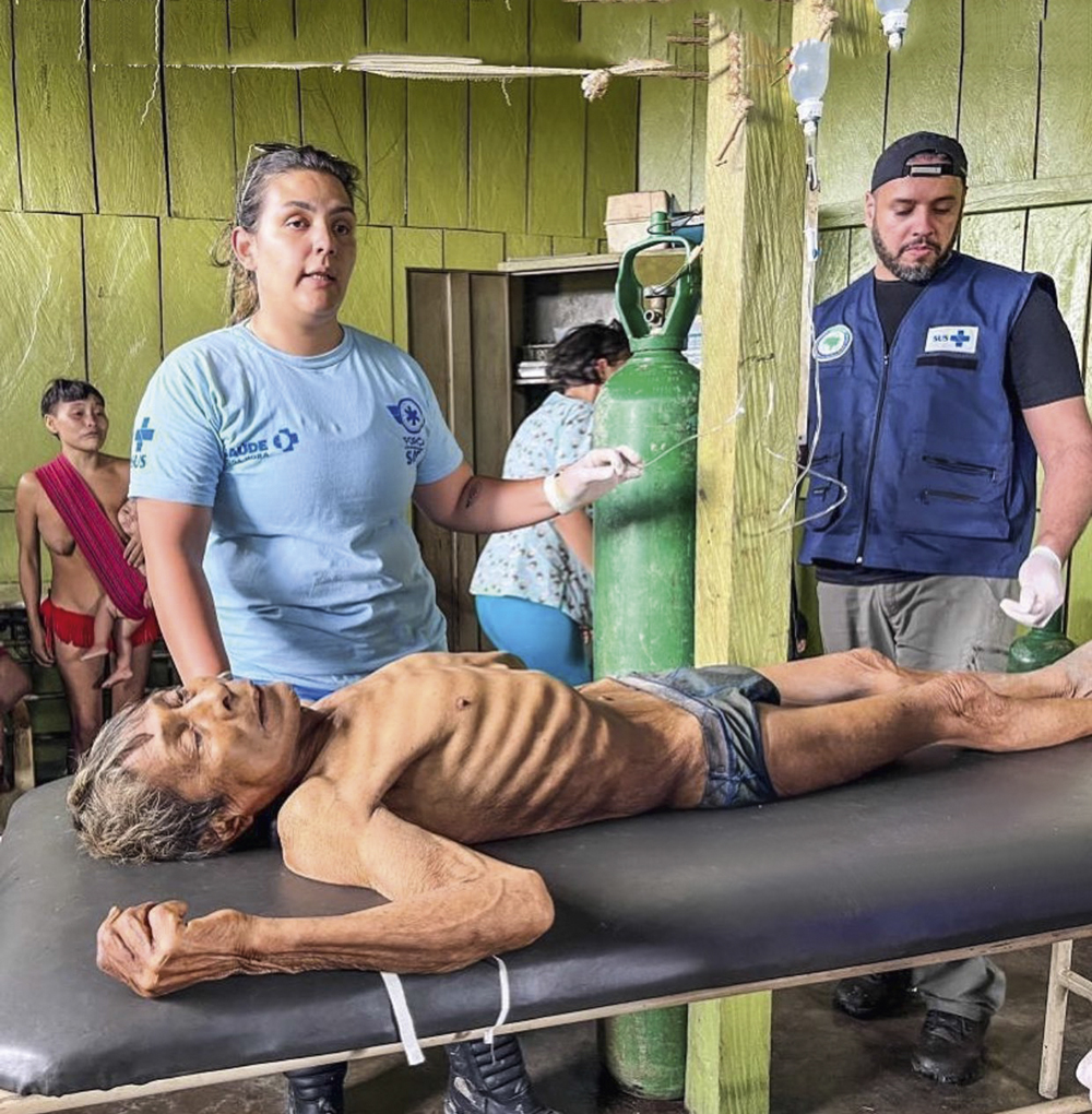 ABRE-IANOMAMI-HOMEM-MACA.jpg2 HORROR - Indígena com desnutrição em Roraima: imagens chocaram o país e correram mundo -