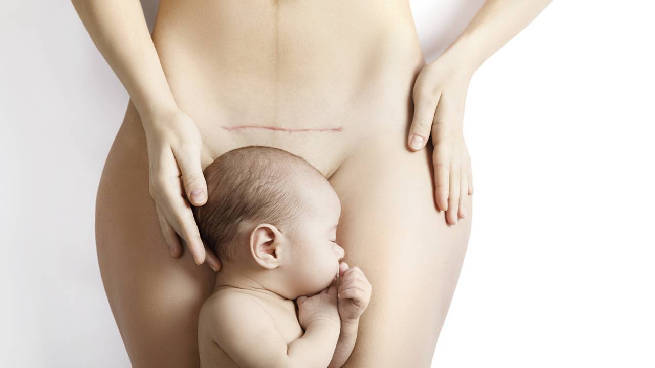 MOMENTO DELICADO - Mãe e bebê: 1 milhão nasceram via cesáreas no último ano -