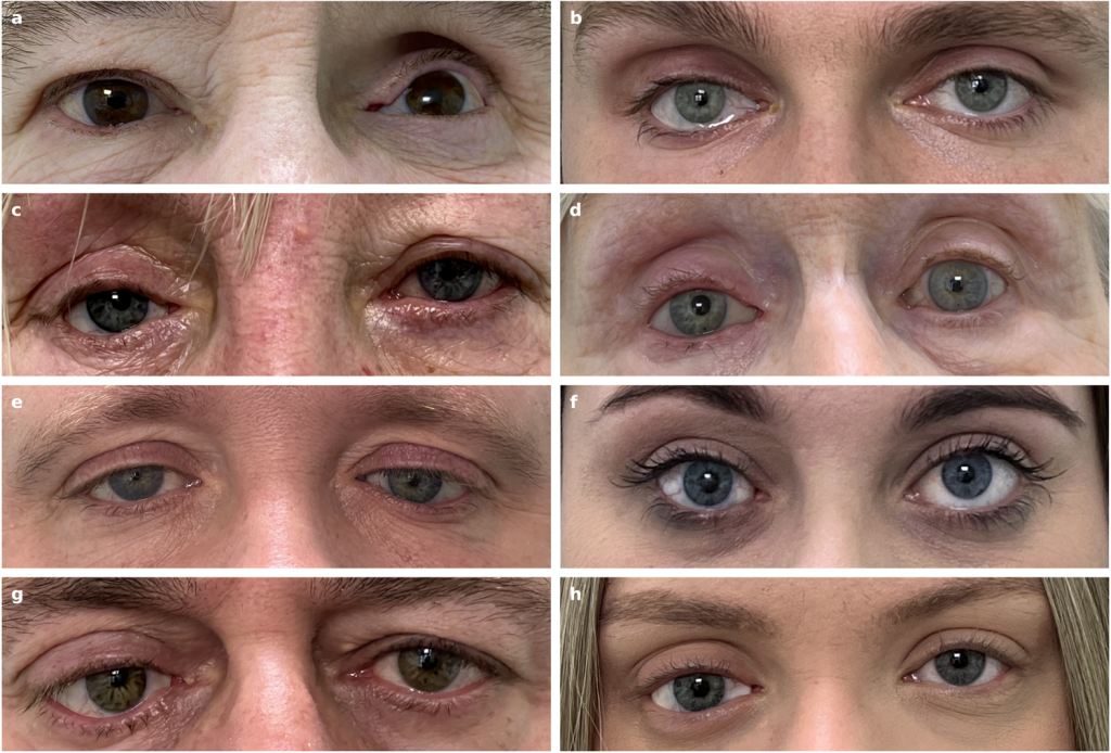 OLHOS FIDEDIGNOS - Próteses: versão artificial é muito semelhante à real