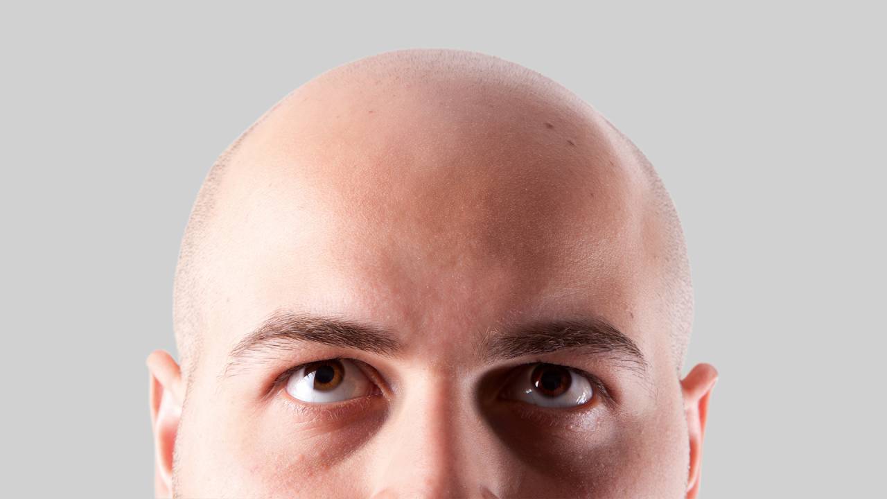 NA CABEÇA DO POVO - Alopecia hereditária: 42 milhões de brasileiros têm calvície; solução vai de spray a transplante