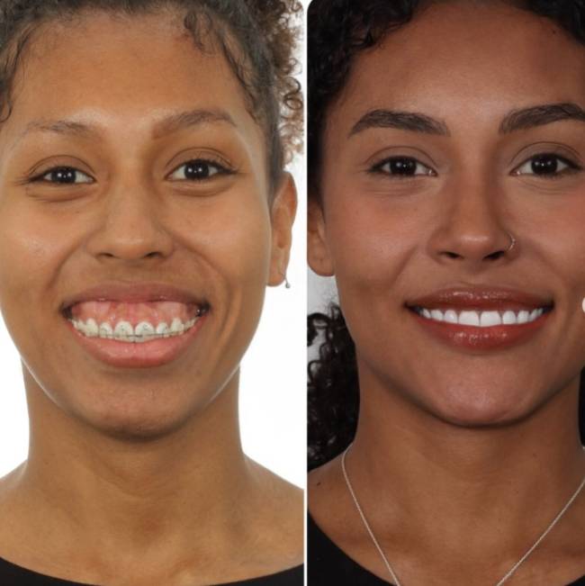giovannajacobina Antes e depois da cirurgia de Giovanna Jacobina, irmã de Gracyanne Barbosa
