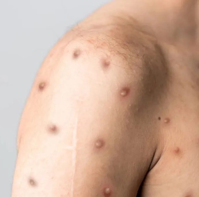 Mpox: novo estado confirma doença viral e número de casos no Brasil se aproxima de 150