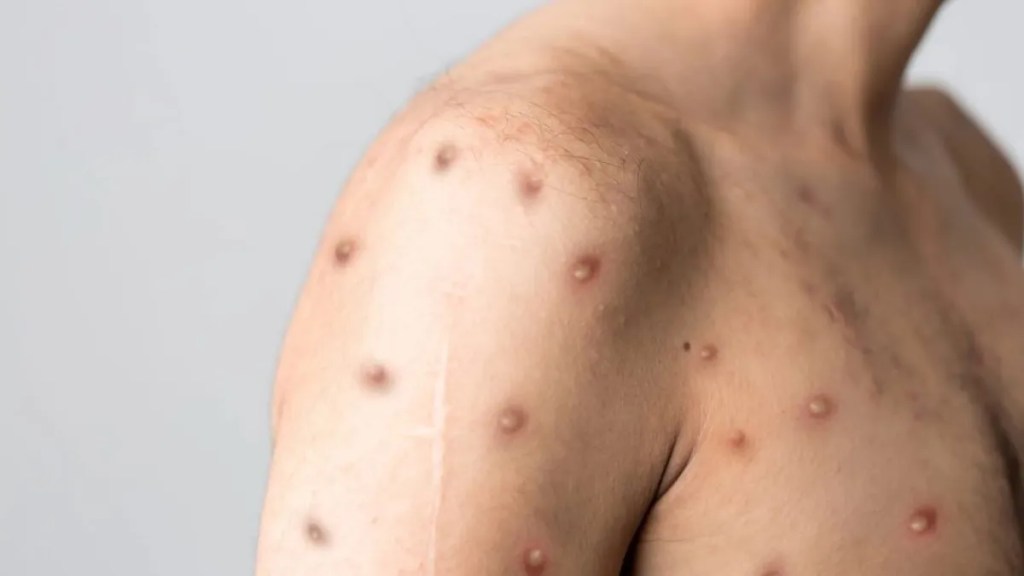 Região Norte do Brasil registra casos de mpox