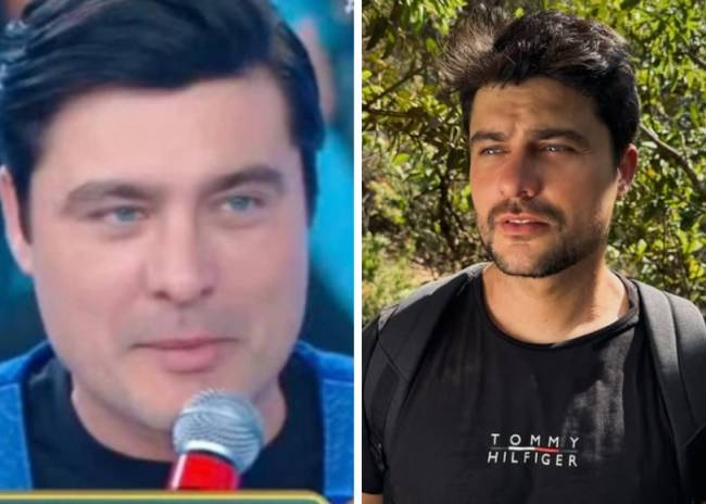 Antes e depois de harmonização facial de Guilherme Leicam
