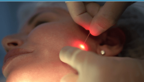 Quem disse que é só a Coreia? Laser da Itália promete acabar com gordura localizada e flacidez, sem cortes