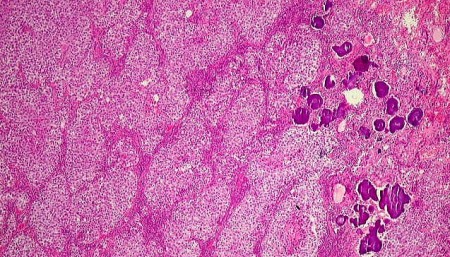 Identificados potenciais alvos terapêuticos contra tipos raros de câncer infantil