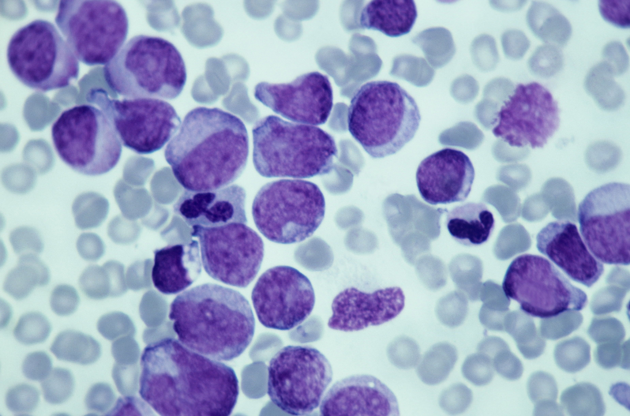 Leukemia; myeloid, 250X at 35mm. This type of leukemia has its origin in the bone marrow (myeloid tissue). It involves a malignant proliferation of immature white blood cells. This action can crowd out production of RBC s and platelets leading to an