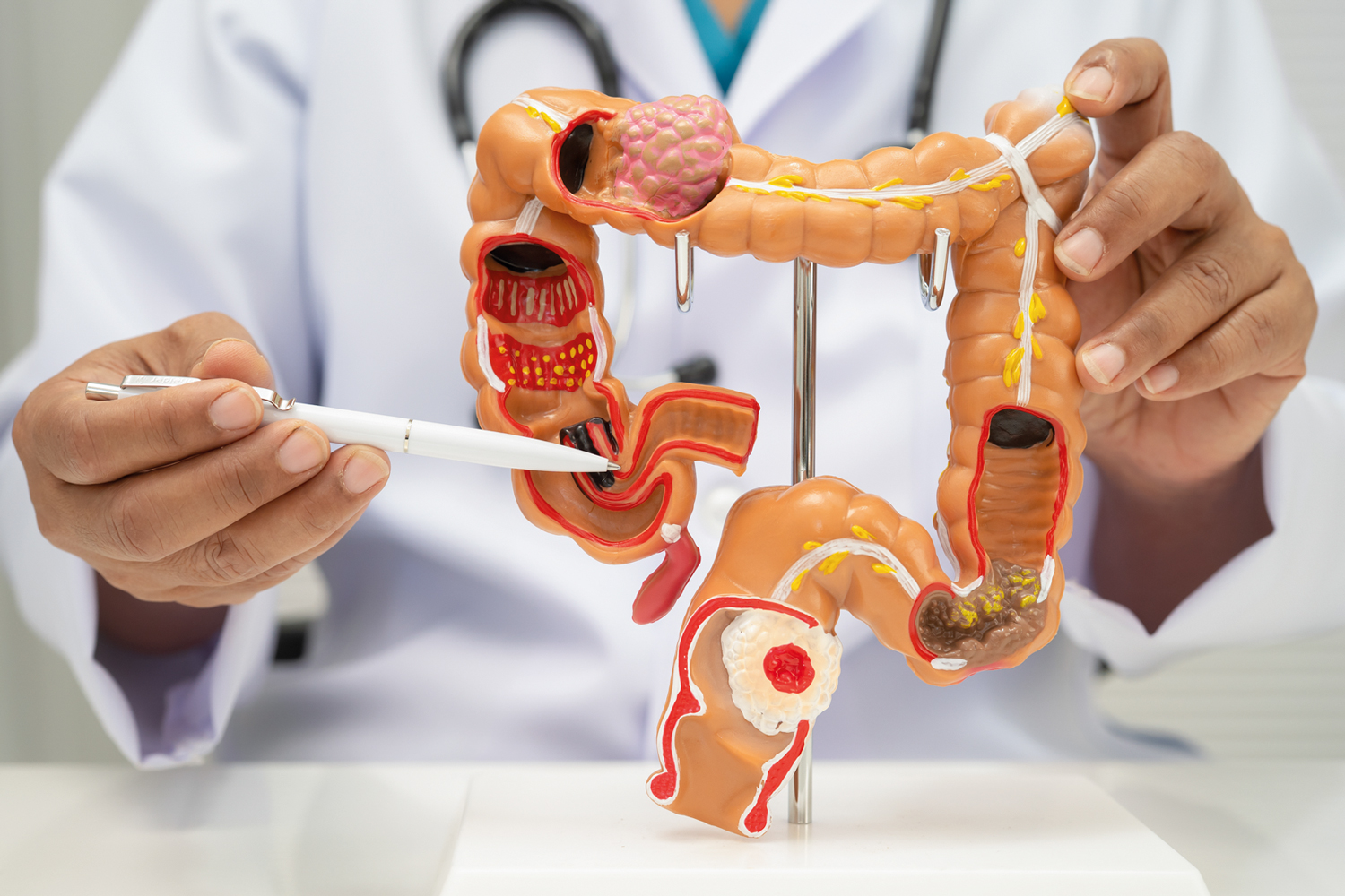 DOEN&Ccedil;A EM ALTA -&ensp;Tumor de intestino: mais de 45&thinsp;000 casos por ano no Brasil