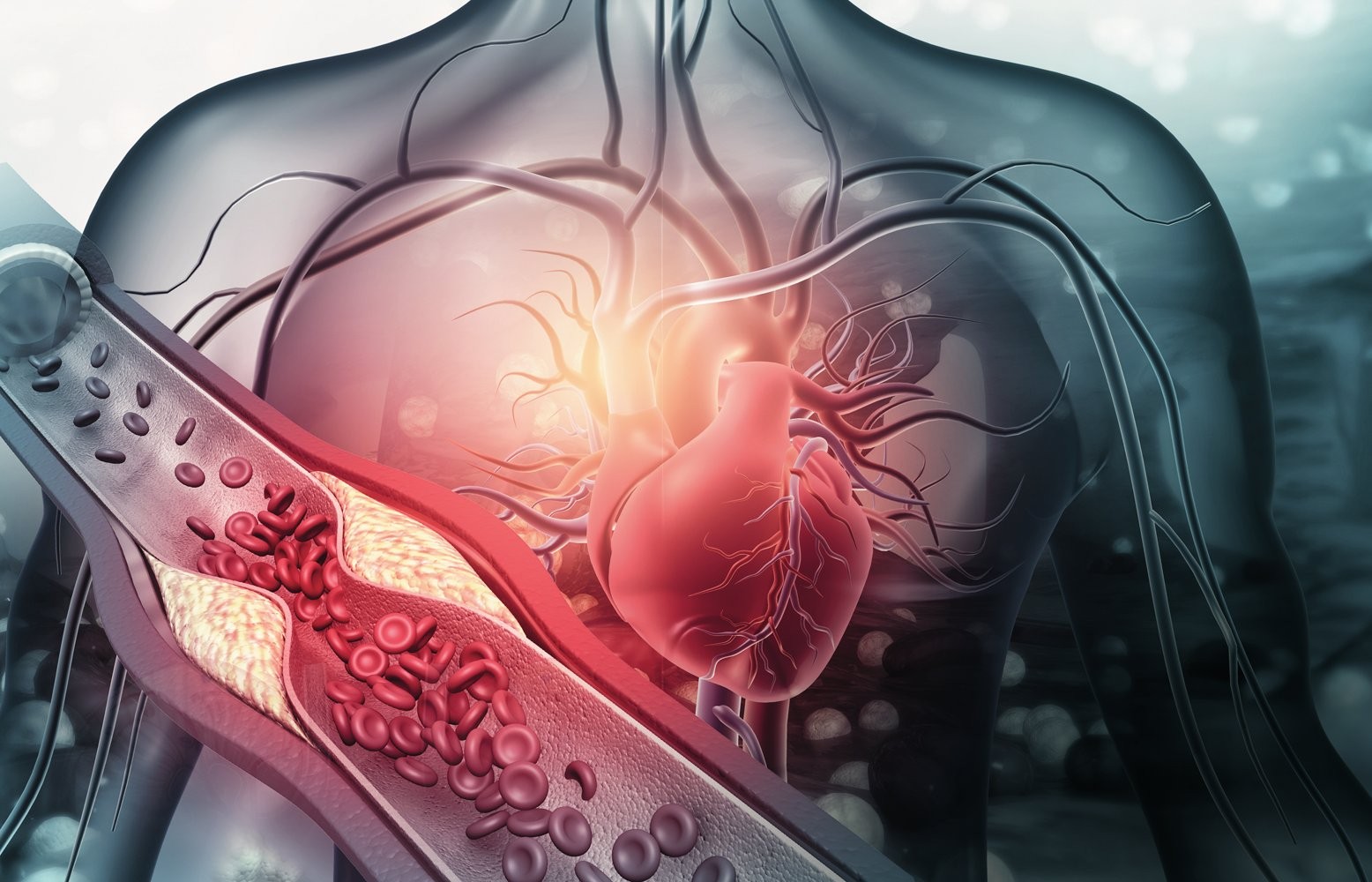 PERIGO SILENCIOSO - Amea&ccedil;a conhecida: placas de gordura que levam a infartos e AVCs