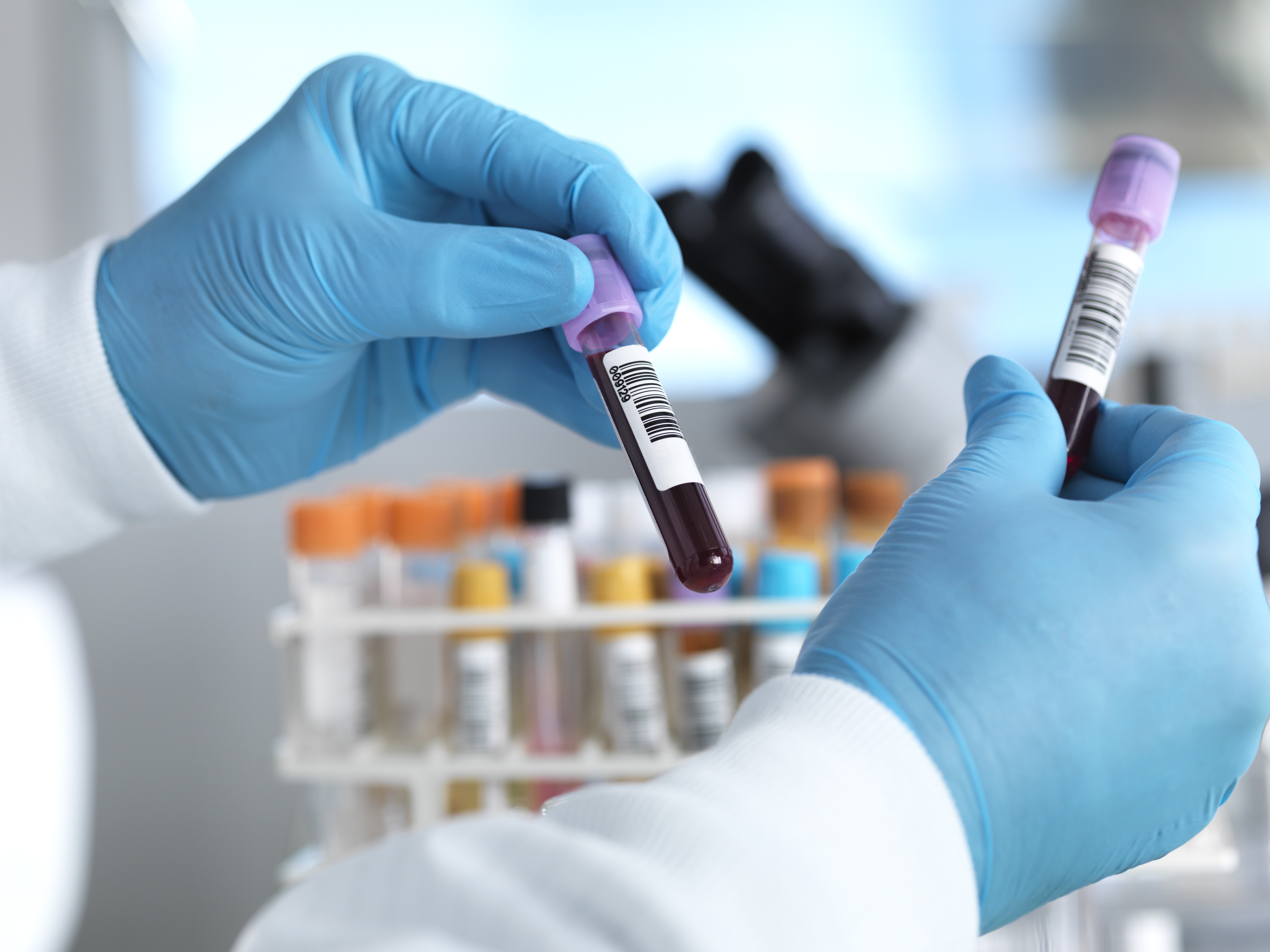 Exame de sangue para auxiliar no diagnóstico de Alzheimer chega ao Brasil